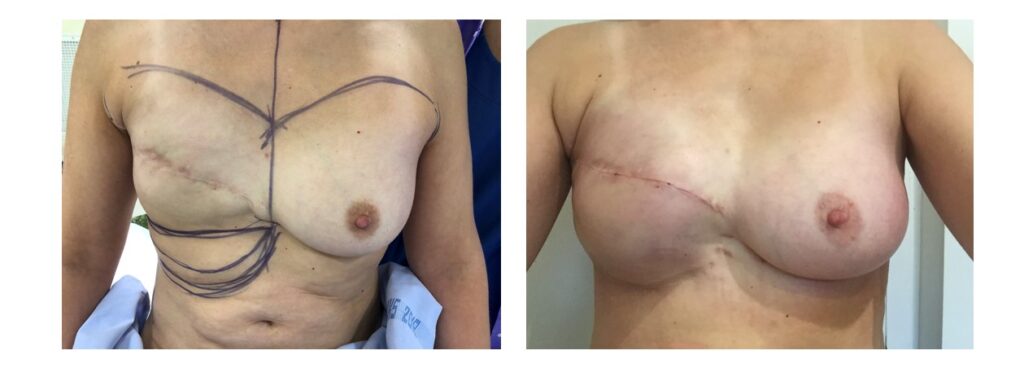 Reconstruction-mammaire-différée
