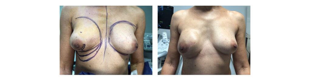Reconstruction-mammaire-par-prothèse-et-lambeau-d’avancement-abdominale (1)