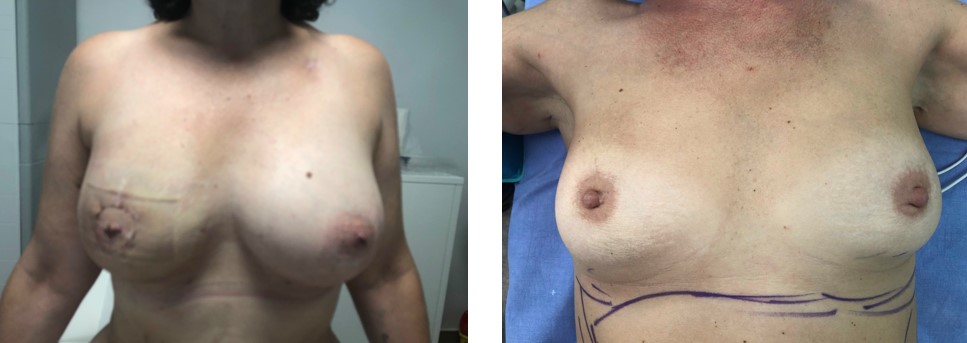 reconstruction_mammaire (1)